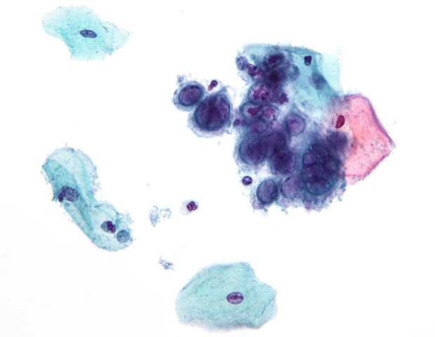 Tampone vaginale HPV DNA